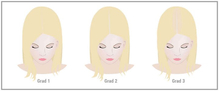 Schematische Darstellung des Haarausfalls bei Frauen. Grad 1: weniger Wachstum an Scheitel und Schläfe, Grad 2: deutlich weniger Wachstum am Scheitel, Grad 3: deutlich sichtbarer Haarverlust im Scheitelbereich